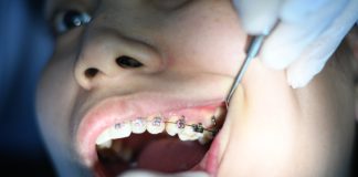 Pineapple Juice Wisdom Teeth dentist checking wisdom tooth